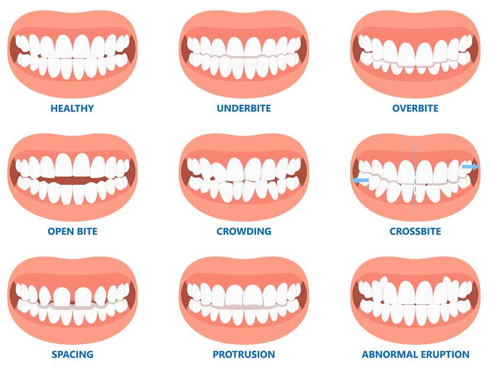An illustration showing the different types of bite problems patients may have
