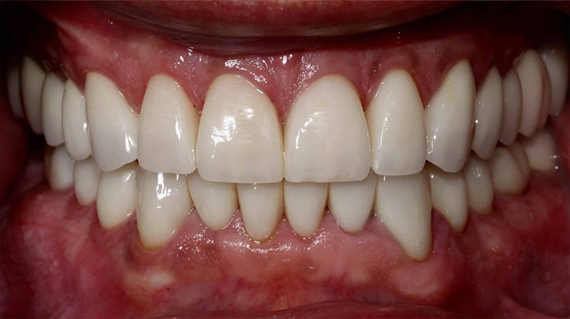 A close up photo of a patient's crooked teeth after receiving treatment