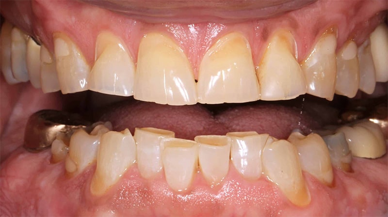 A close up photo of a patient's crooked teeth before receiving treatment