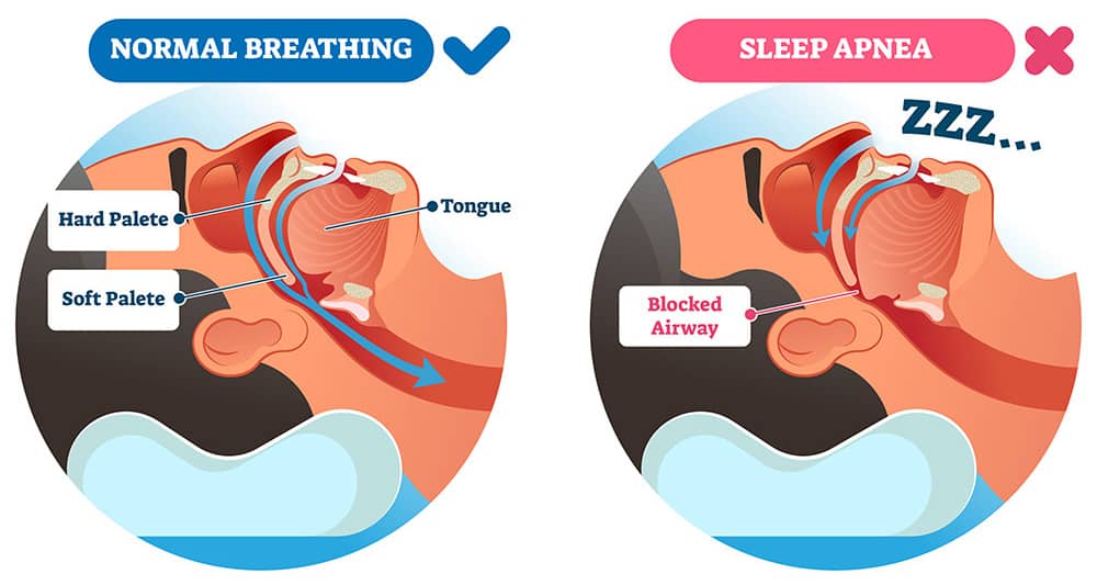 An illustration comparing normal breathing and a closed airway