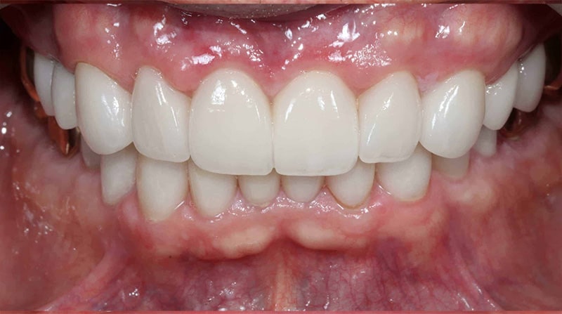 A close up photo of a patient's stained, discolored teeth after receiving treatment