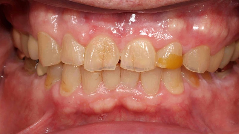 A close up photo of a patient's stained, discolored teeth before receiving treatment