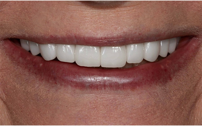 A close up photo of a patient's worn teeth after receiving treatment