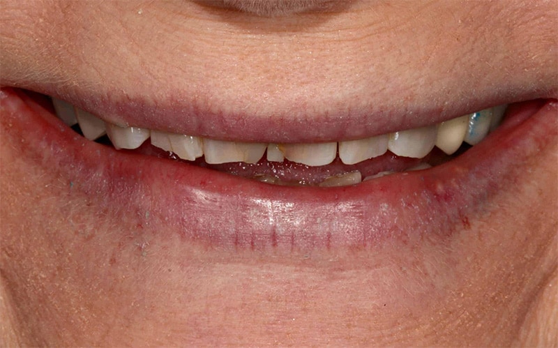 A close up photo of a patient's worn teeth before receiving treatment