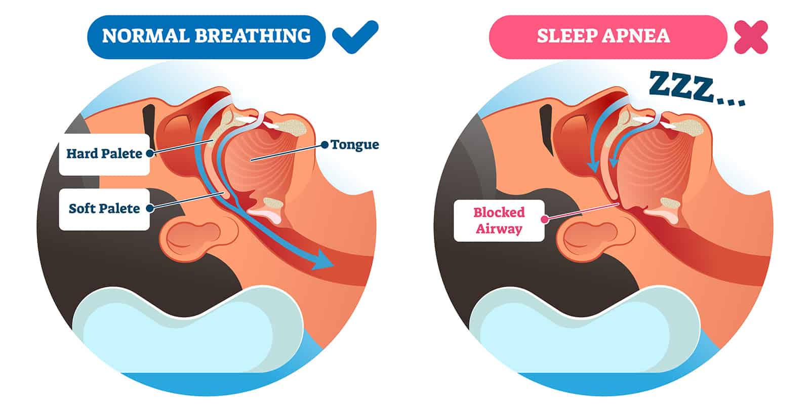 A medical illustration comparing normal breathing and a closed airway